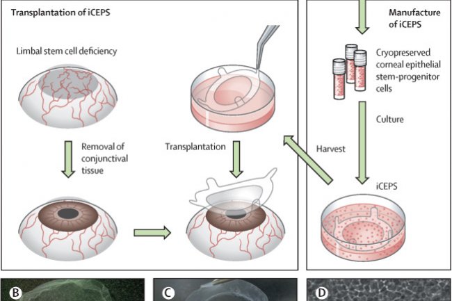 Scientists have restored vision in patients using stem cells